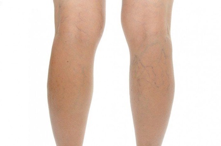 Визуально определить варикоз можно не всегда