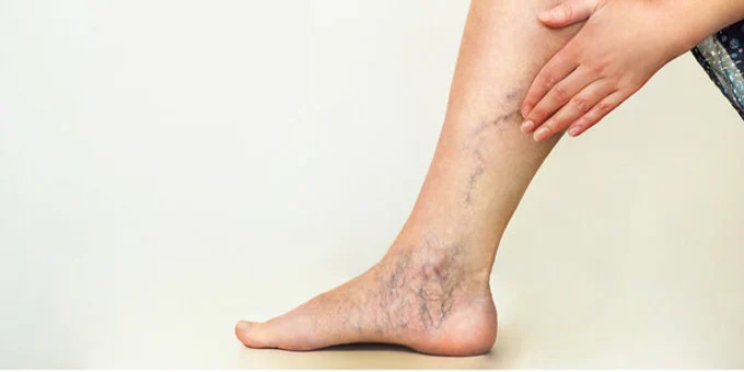 Визуально определить варикоз можно не всегда