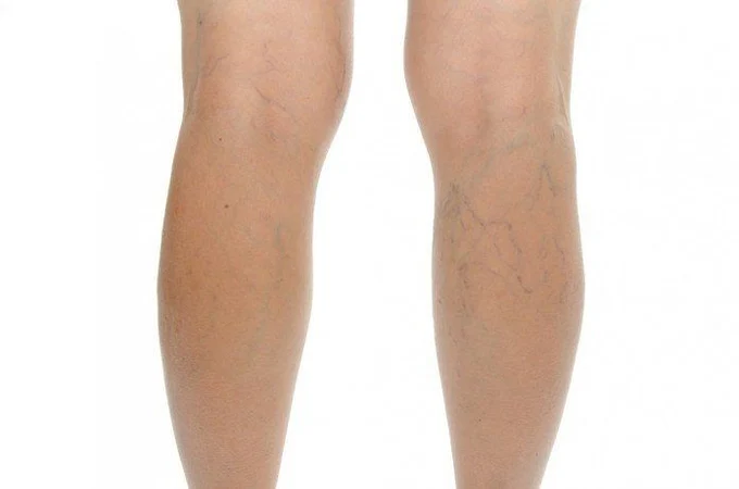 Визуально определить варикоз можно не всегда